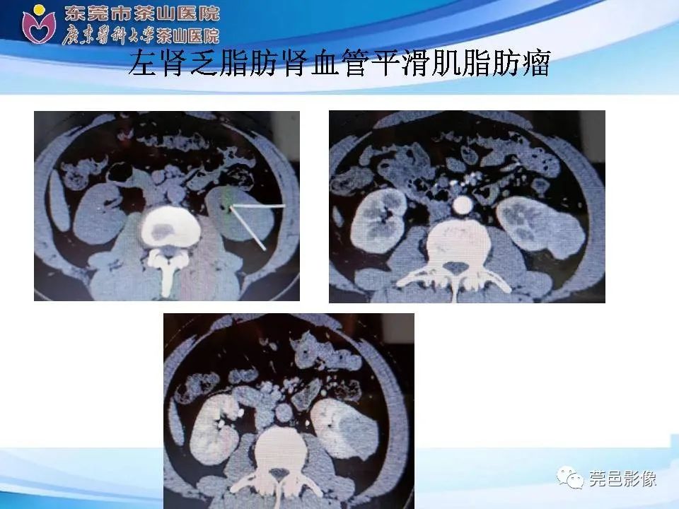 影像PPT - 【PPT】乏脂肪肾血管平滑肌脂肪瘤影像诊断-21