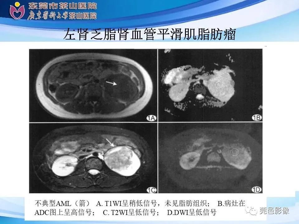 影像PPT - 【PPT】乏脂肪肾血管平滑肌脂肪瘤影像诊断-20