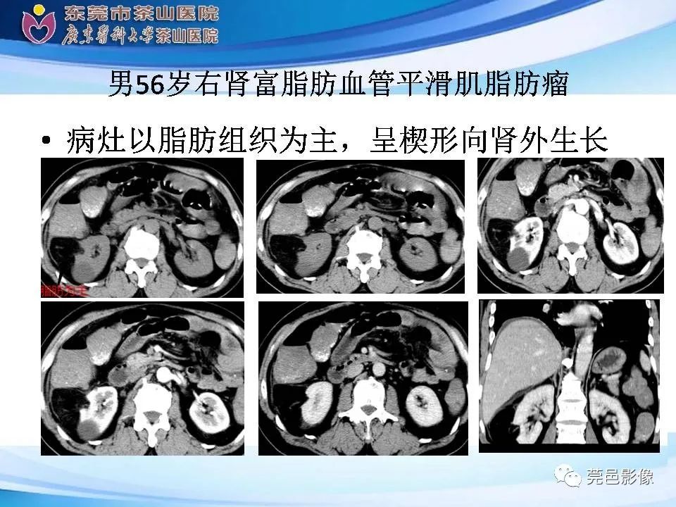 影像PPT - 【PPT】乏脂肪肾血管平滑肌脂肪瘤影像诊断-18
