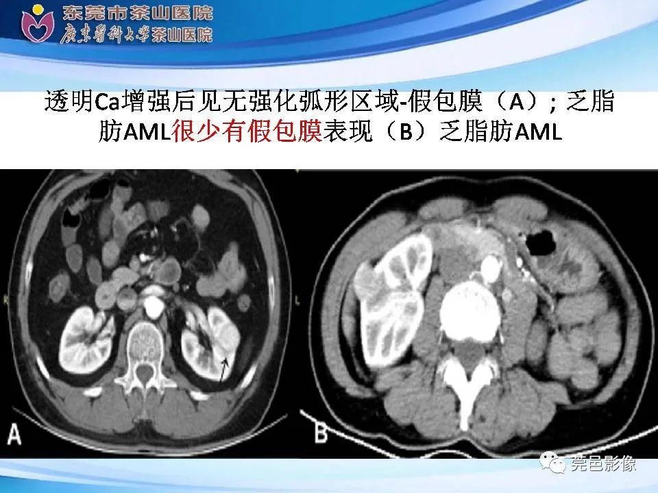 影像PPT - 【PPT】乏脂肪肾血管平滑肌脂肪瘤影像诊断-23