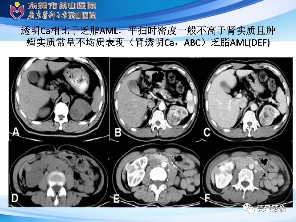 影像PPT - 【PPT】乏脂肪肾血管平滑肌脂肪瘤影像诊断-24