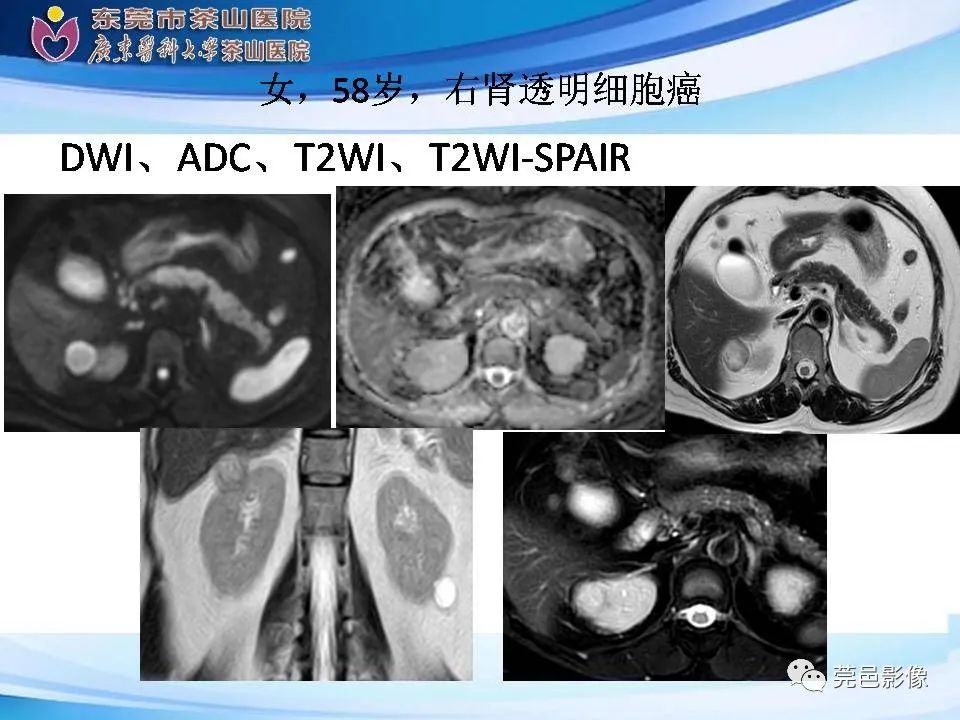 影像PPT - 【PPT】乏脂肪肾血管平滑肌脂肪瘤影像诊断-25