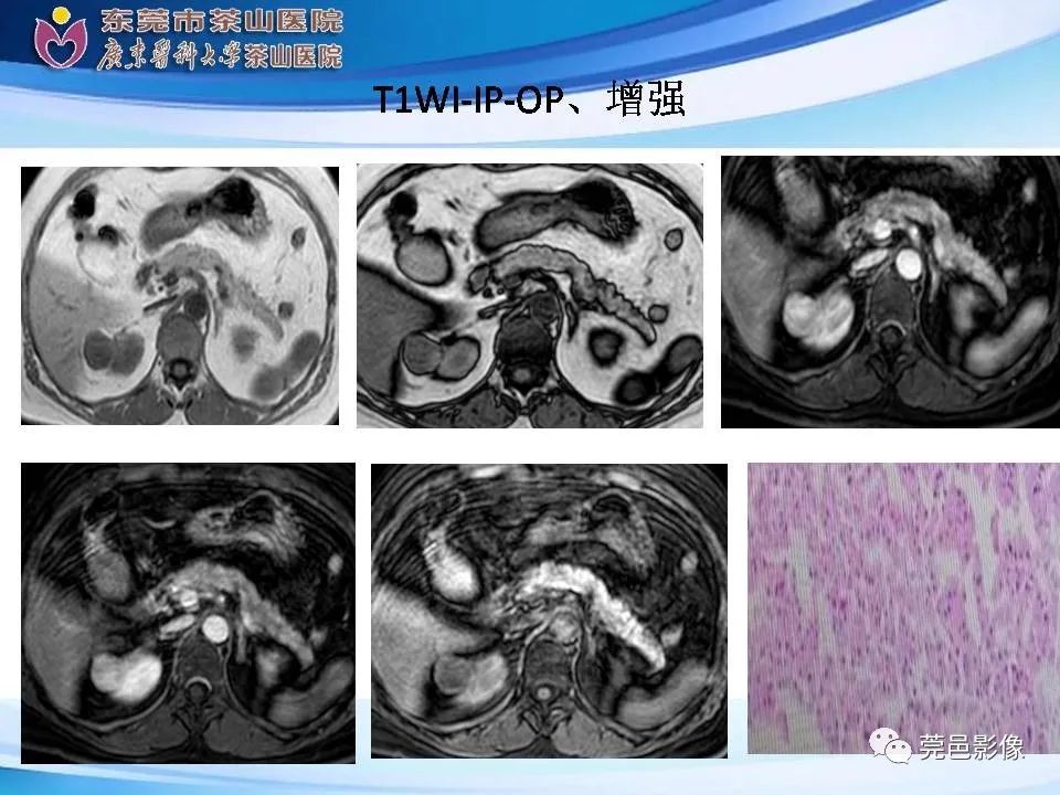 影像PPT - 【PPT】乏脂肪肾血管平滑肌脂肪瘤影像诊断-26