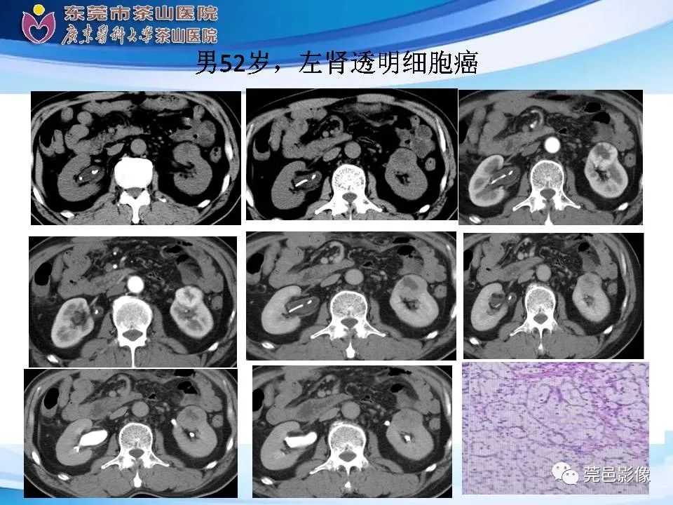 影像PPT - 【PPT】乏脂肪肾血管平滑肌脂肪瘤影像诊断-27