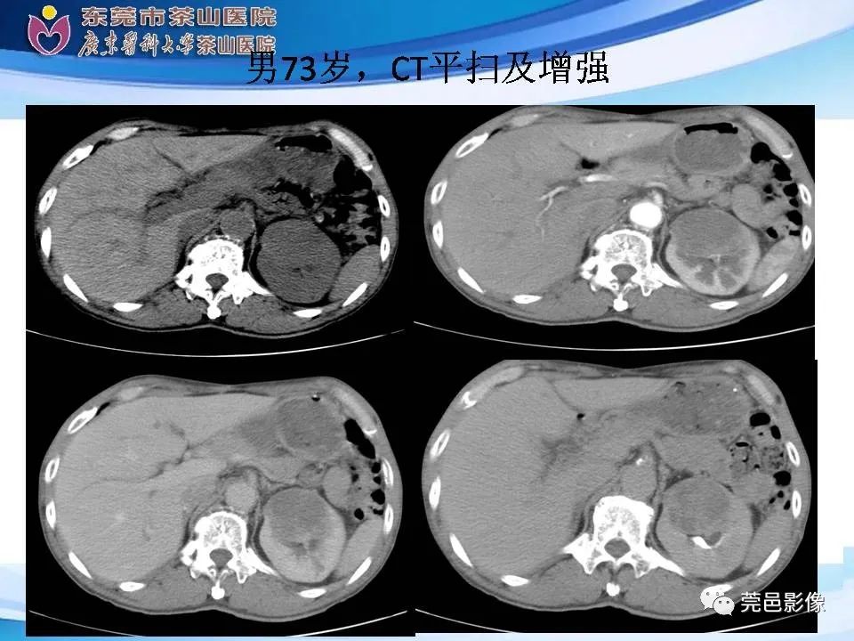 影像PPT - 【PPT】乏脂肪肾血管平滑肌脂肪瘤影像诊断-29