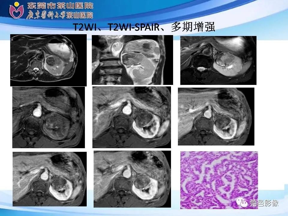 影像PPT - 【PPT】乏脂肪肾血管平滑肌脂肪瘤影像诊断-31