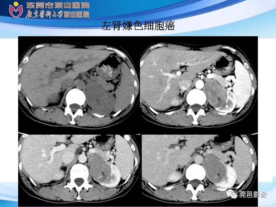影像PPT - 【PPT】乏脂肪肾血管平滑肌脂肪瘤影像诊断-33