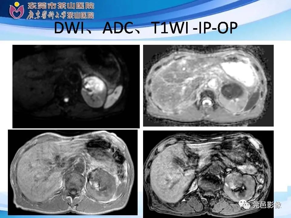 影像PPT - 【PPT】乏脂肪肾血管平滑肌脂肪瘤影像诊断-30