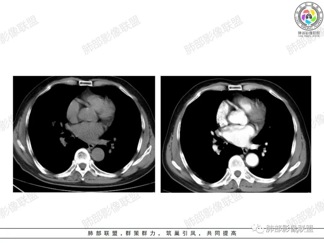 影像PPT - 【病例】小细胞肺癌一图定乾坤—经典蠕虫样改变-9 影像PPT - 【病例】小细胞肺癌一图定乾坤—经典蠕虫样改变-9