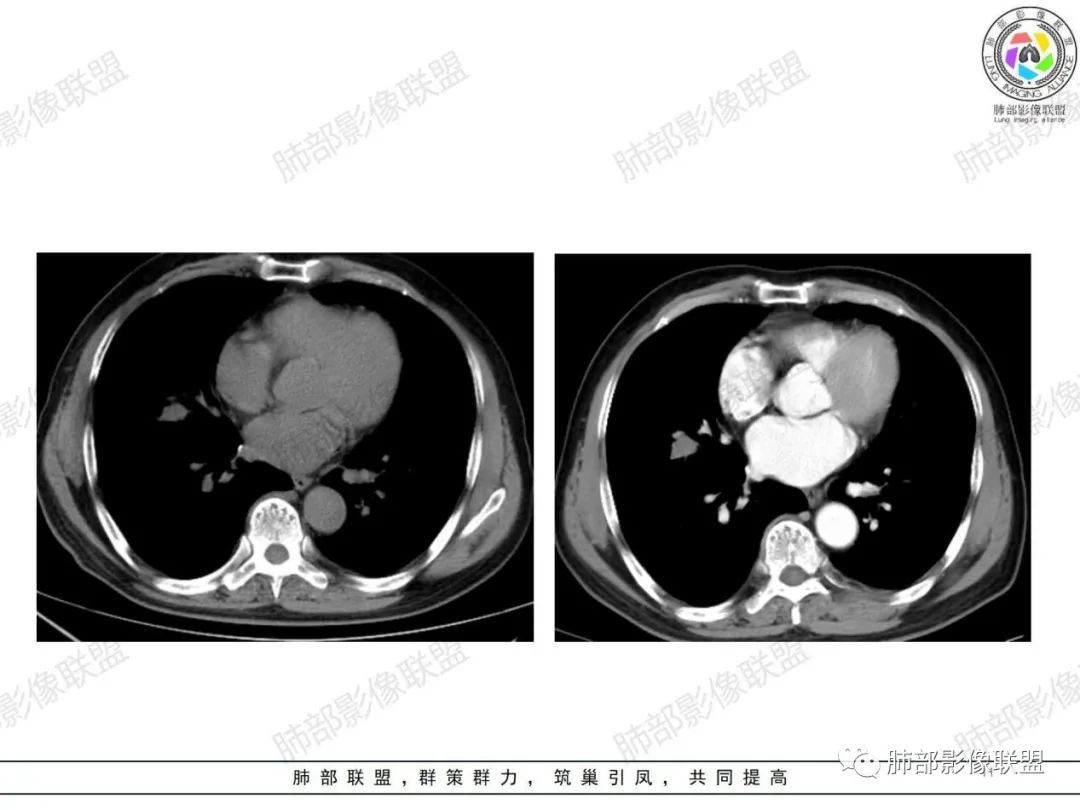 影像PPT - 【病例】小细胞肺癌一图定乾坤—经典蠕虫样改变-11 影像PPT - 【病例】小细胞肺癌一图定乾坤—经典蠕虫样改变-11