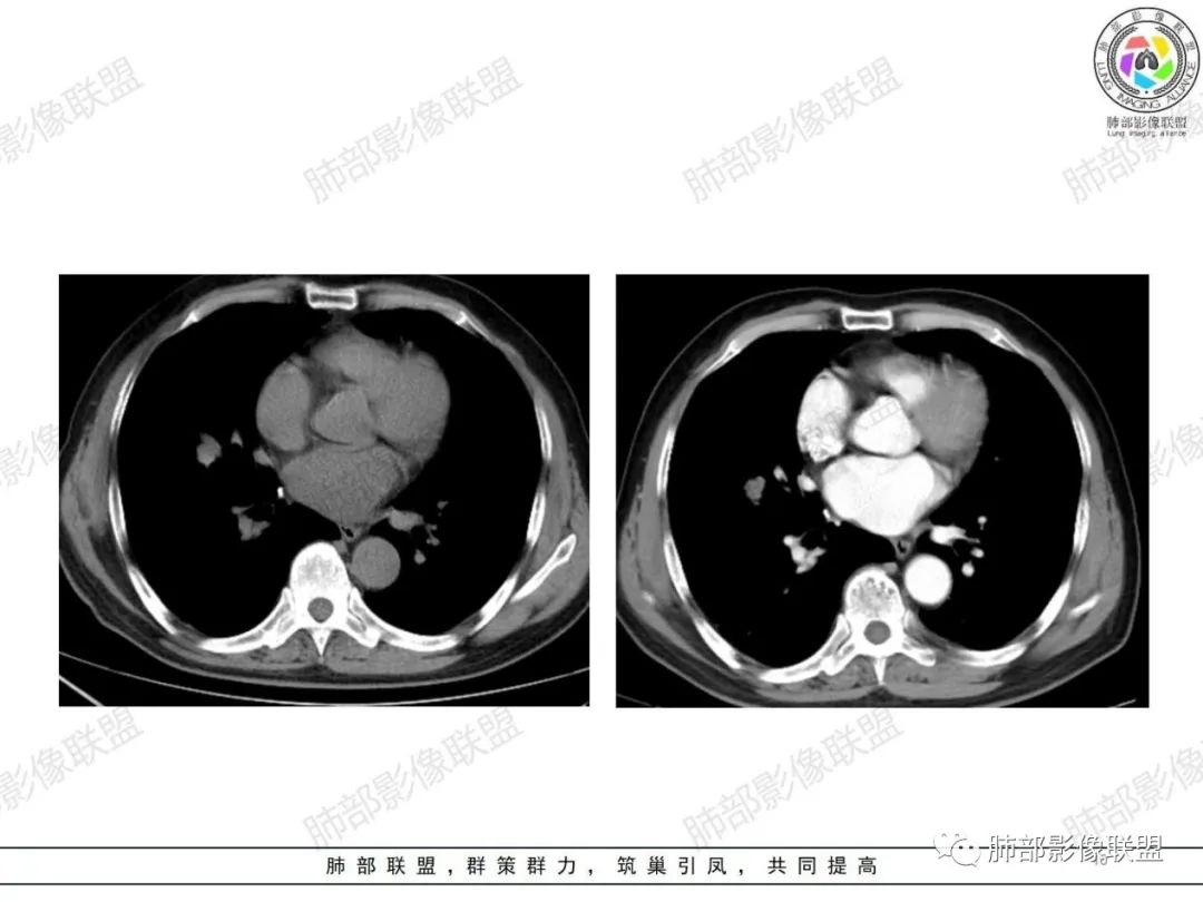 影像PPT - 【病例】小细胞肺癌一图定乾坤—经典蠕虫样改变-10 影像PPT - 【病例】小细胞肺癌一图定乾坤—经典蠕虫样改变-10