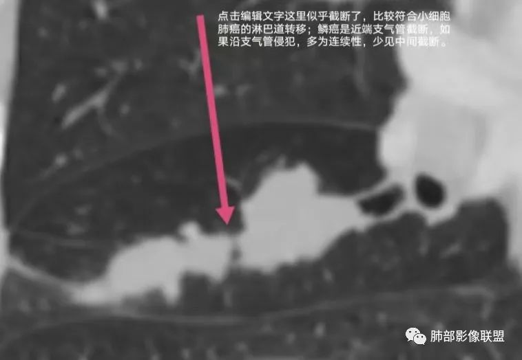 影像PPT - 【病例】小细胞肺癌一图定乾坤—经典蠕虫样改变-26 影像PPT - 【病例】小细胞肺癌一图定乾坤—经典蠕虫样改变-26