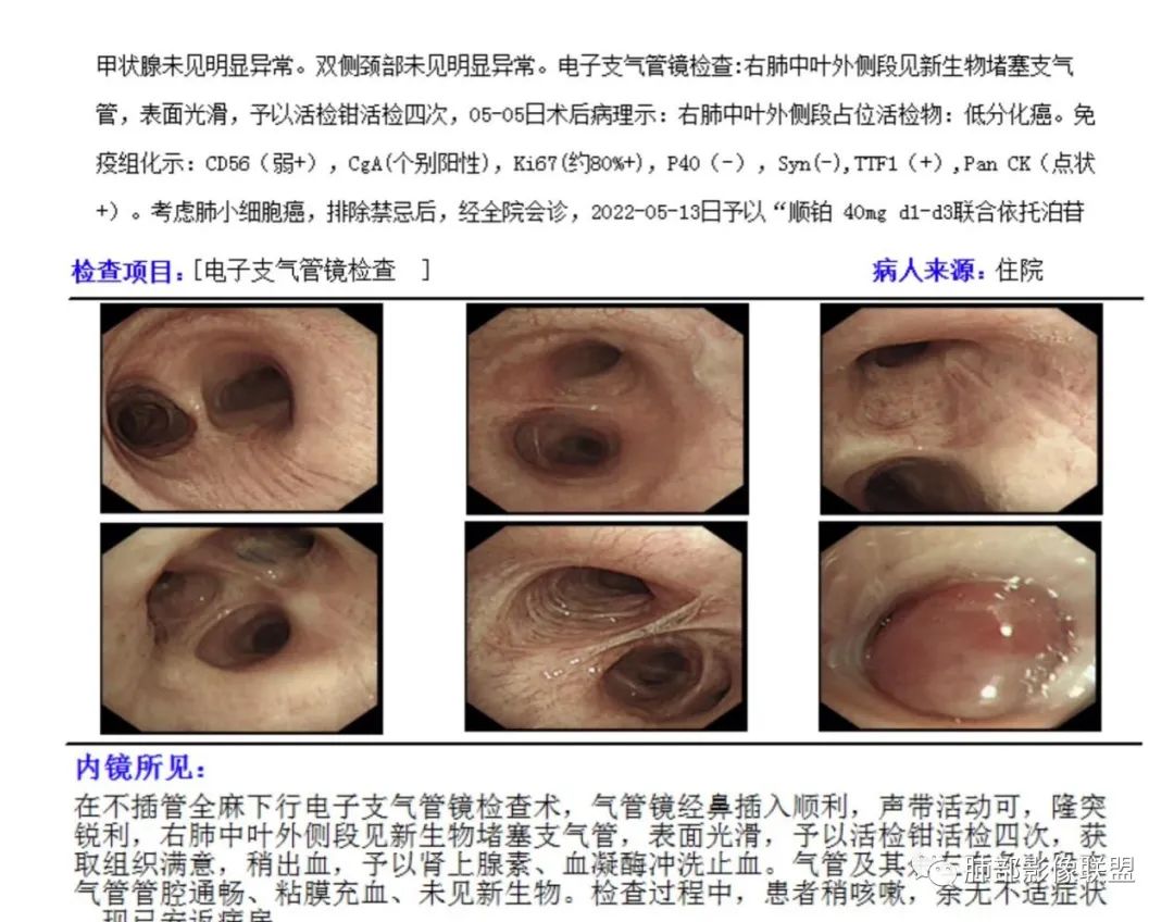 影像PPT - 【病例】小细胞肺癌一图定乾坤—经典蠕虫样改变-31 影像PPT - 【病例】小细胞肺癌一图定乾坤—经典蠕虫样改变-31