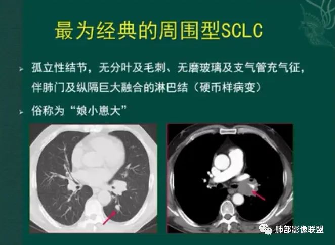 影像PPT - 【病例】小细胞肺癌一图定乾坤—经典蠕虫样改变-36 影像PPT - 【病例】小细胞肺癌一图定乾坤—经典蠕虫样改变-36