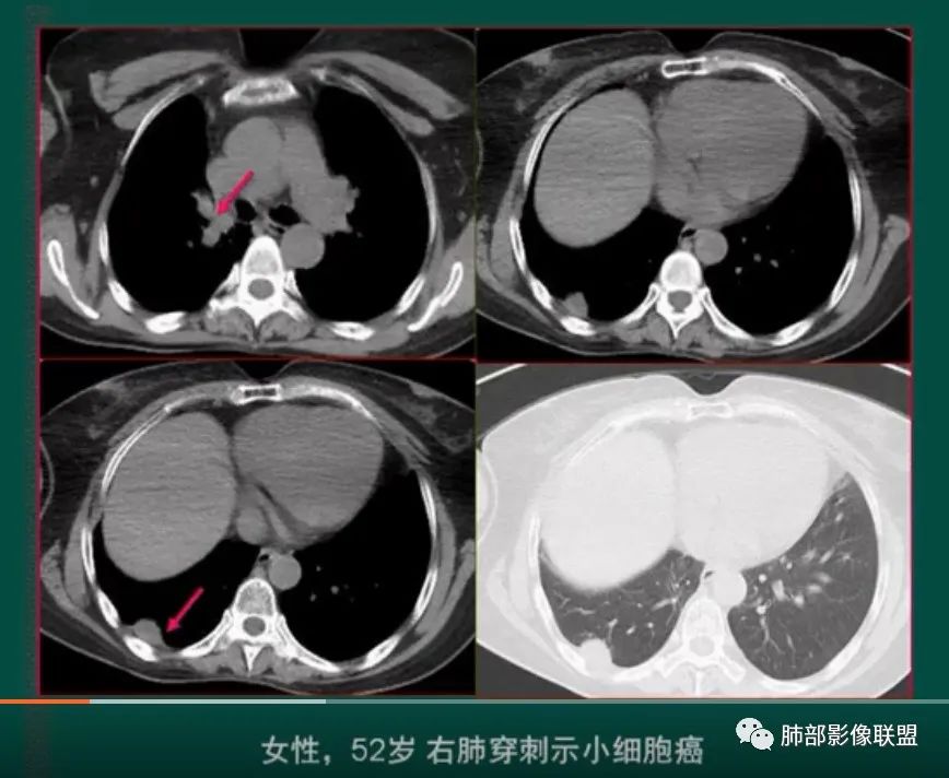 影像PPT - 【病例】小细胞肺癌一图定乾坤—经典蠕虫样改变-38 影像PPT - 【病例】小细胞肺癌一图定乾坤—经典蠕虫样改变-38