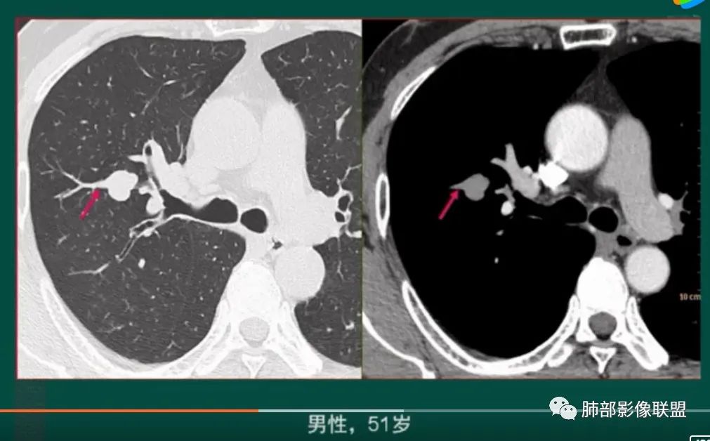 影像PPT - 【病例】小细胞肺癌一图定乾坤—经典蠕虫样改变-42 影像PPT - 【病例】小细胞肺癌一图定乾坤—经典蠕虫样改变-42