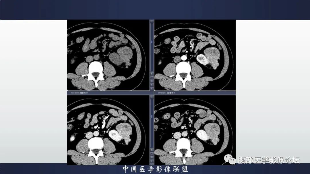 影像PPT - 【病例】肾脏上皮样血管平滑肌脂肪瘤1例CT影像诊断-5