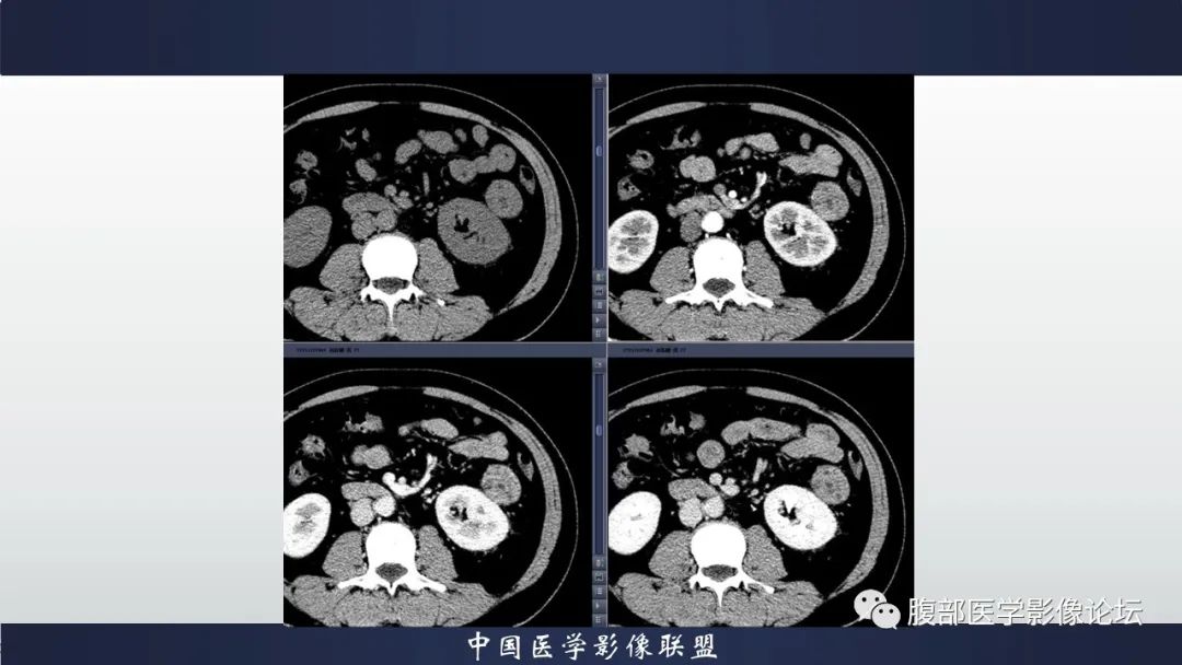影像PPT - 【病例】肾脏上皮样血管平滑肌脂肪瘤1例CT影像诊断-3
