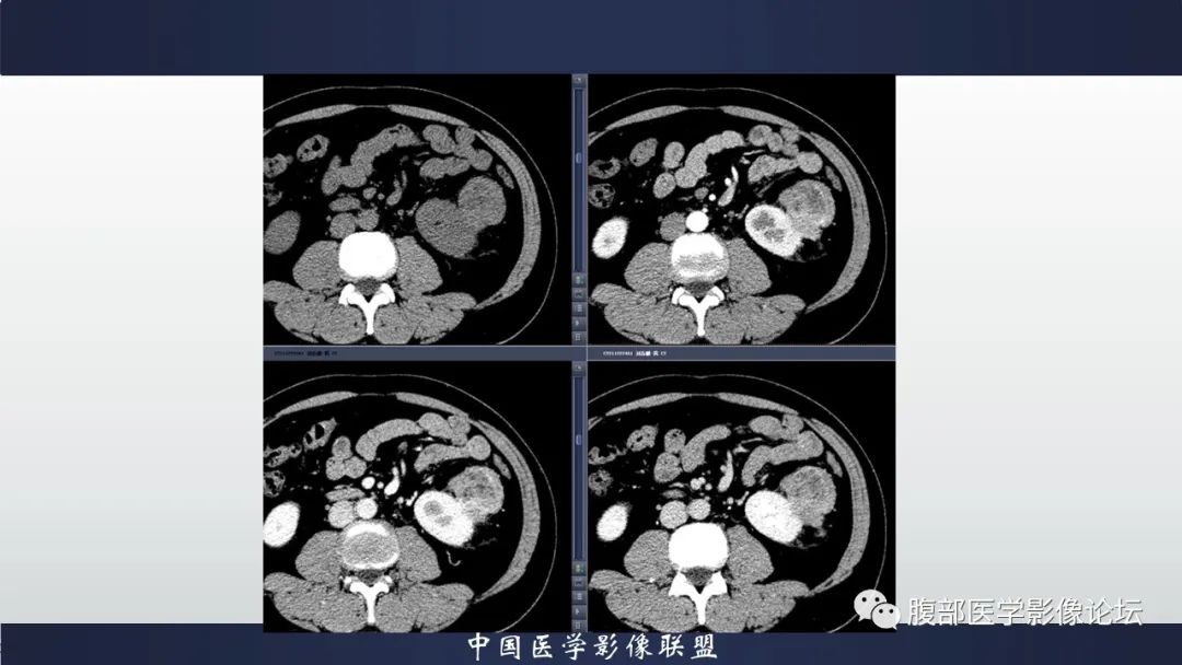 影像PPT - 【病例】肾脏上皮样血管平滑肌脂肪瘤1例CT影像诊断-4