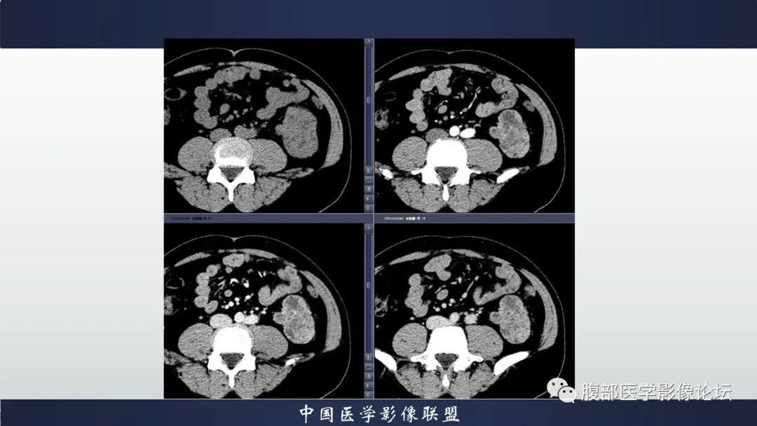 影像PPT - 【病例】肾脏上皮样血管平滑肌脂肪瘤1例CT影像诊断-6