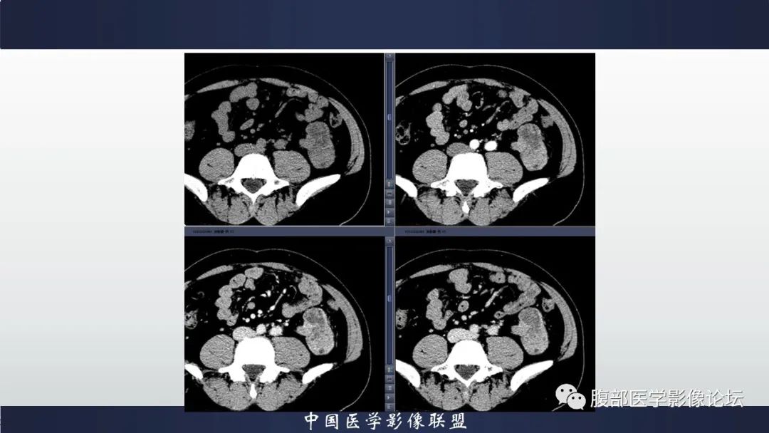 影像PPT - 【病例】肾脏上皮样血管平滑肌脂肪瘤1例CT影像诊断-7