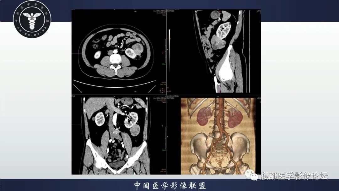 影像PPT - 【病例】肾脏上皮样血管平滑肌脂肪瘤1例CT影像诊断-8