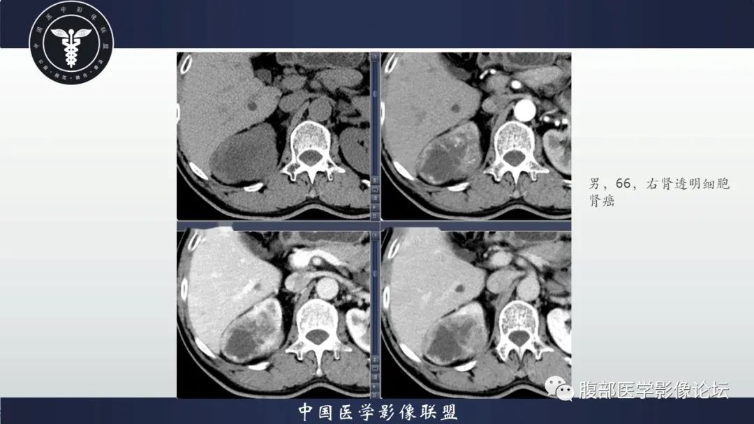 影像PPT - 【病例】肾脏上皮样血管平滑肌脂肪瘤1例CT影像诊断-12