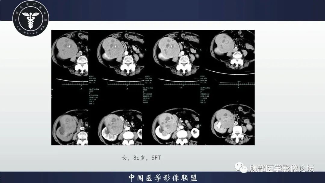 影像PPT - 【病例】肾脏上皮样血管平滑肌脂肪瘤1例CT影像诊断-14