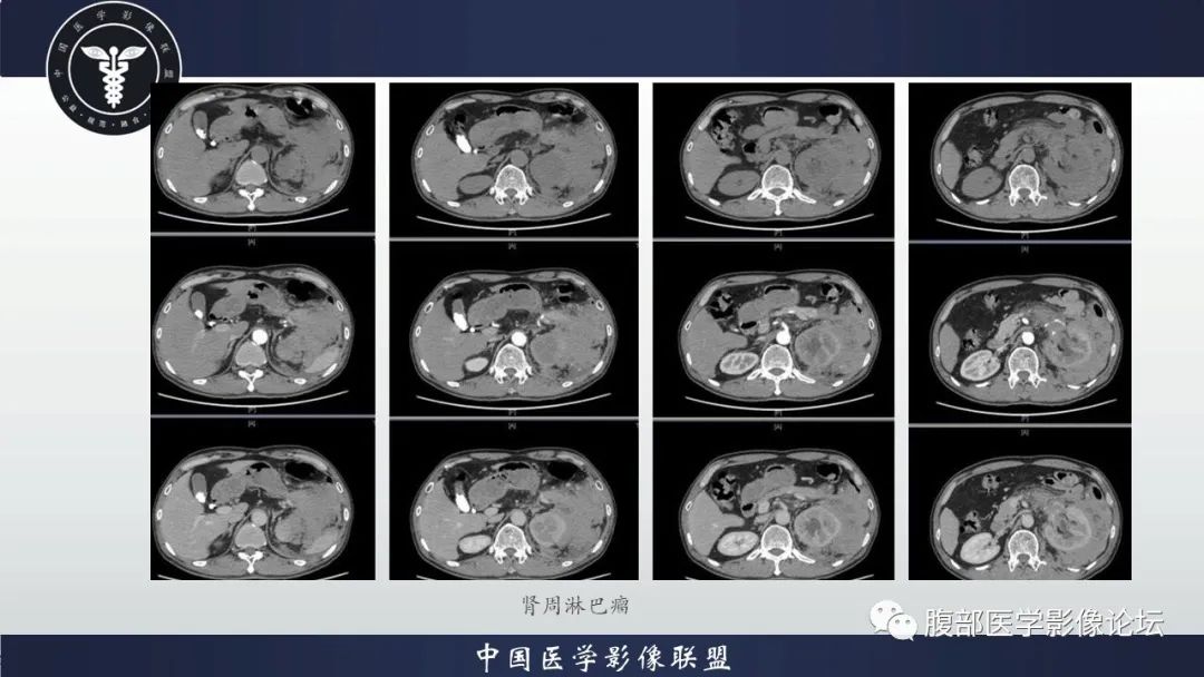 影像PPT - 【病例】肾脏上皮样血管平滑肌脂肪瘤1例CT影像诊断-16