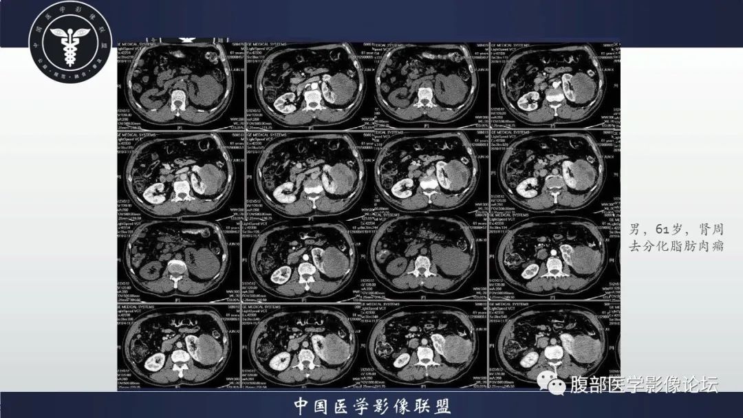 影像PPT - 【病例】肾脏上皮样血管平滑肌脂肪瘤1例CT影像诊断-18
