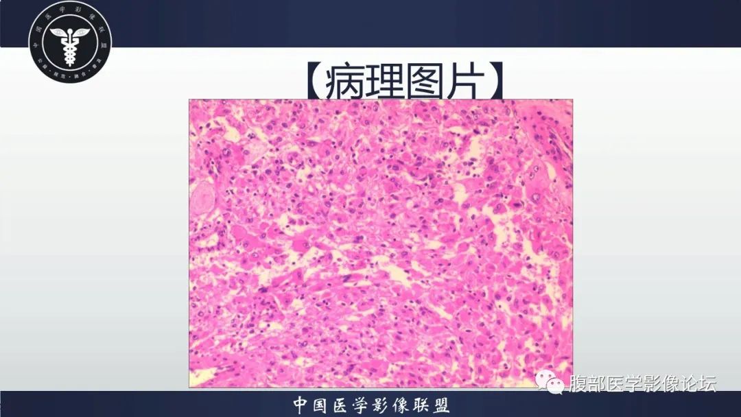 影像PPT - 【病例】肾脏上皮样血管平滑肌脂肪瘤1例CT影像诊断-20