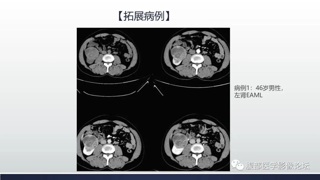 影像PPT - 【病例】肾脏上皮样血管平滑肌脂肪瘤1例CT影像诊断-24