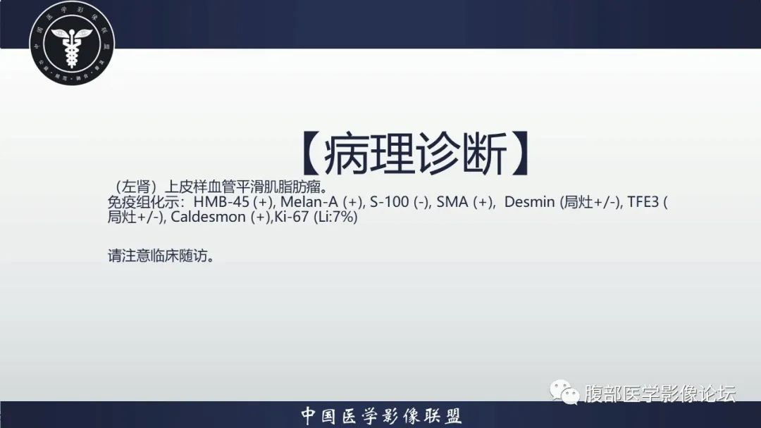 影像PPT - 【病例】肾脏上皮样血管平滑肌脂肪瘤1例CT影像诊断-19