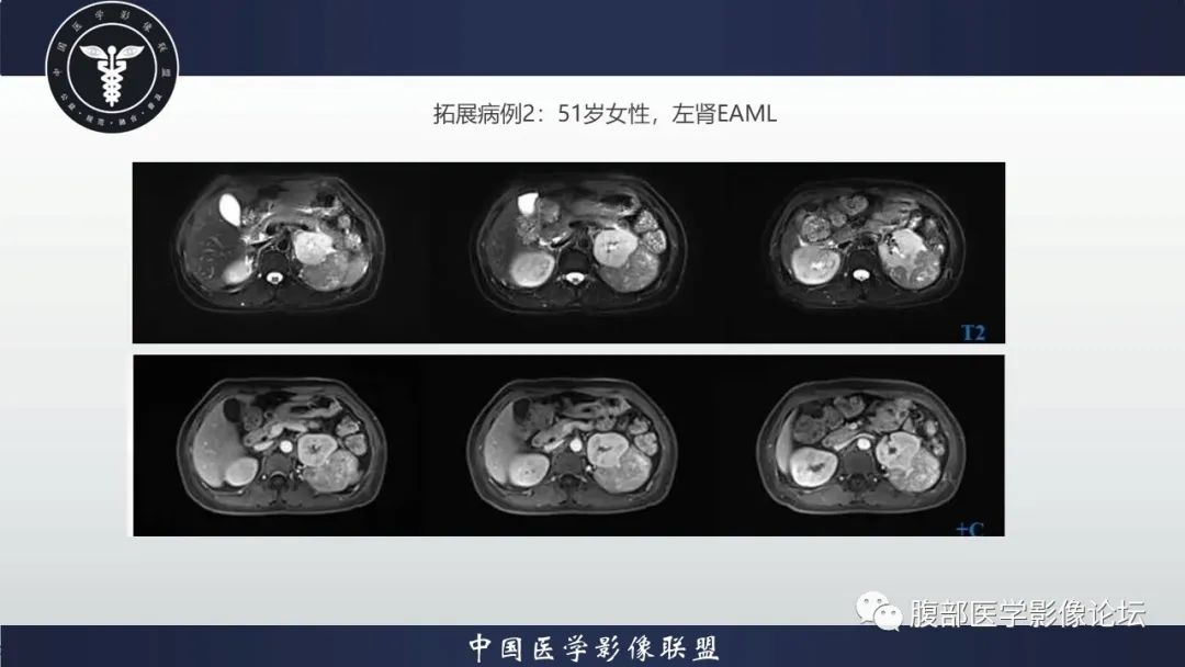 影像PPT - 【病例】肾脏上皮样血管平滑肌脂肪瘤1例CT影像诊断-25