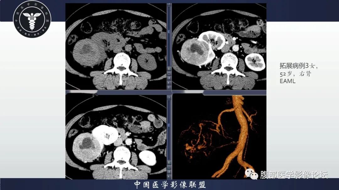 影像PPT - 【病例】肾脏上皮样血管平滑肌脂肪瘤1例CT影像诊断-26