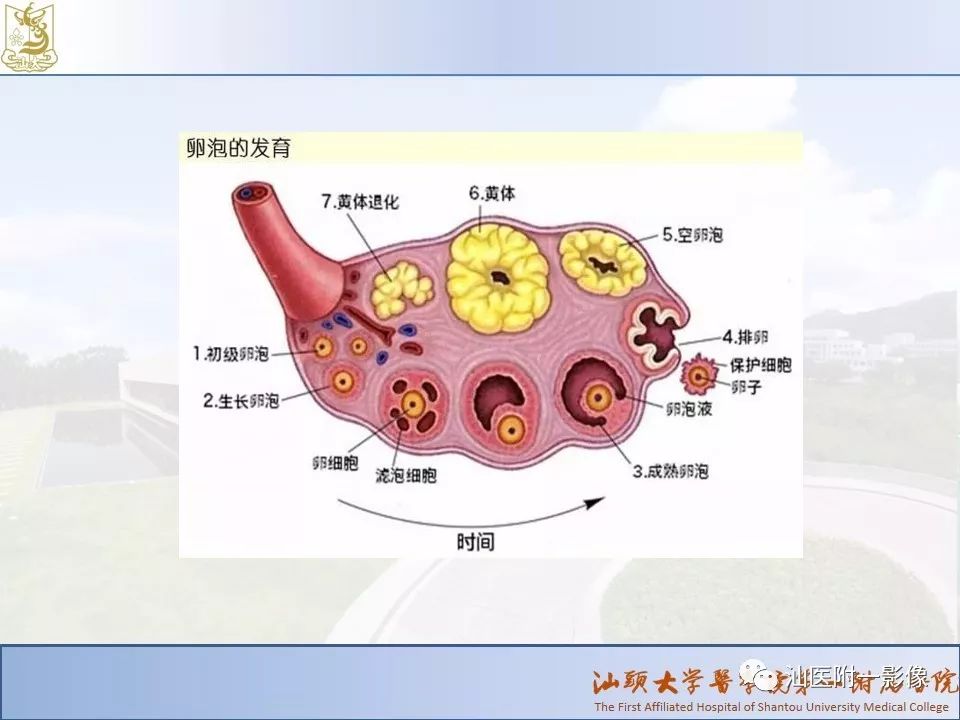 影像PPT - 【PPT】妇科急腹症的CT和MRI诊断-4