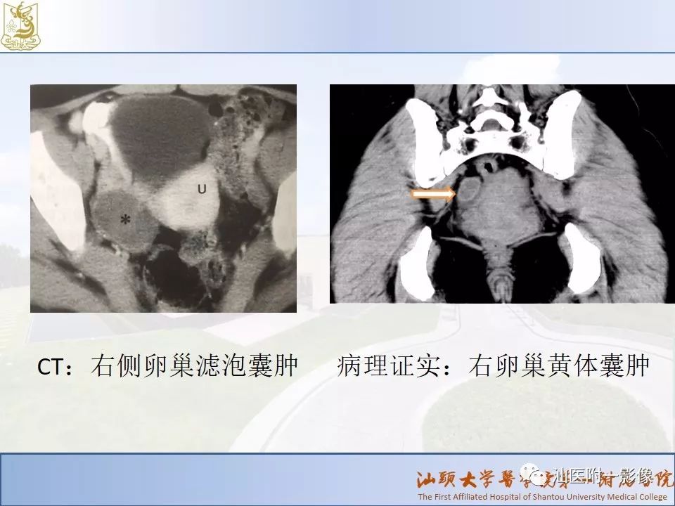 影像PPT - 【PPT】妇科急腹症的CT和MRI诊断-7