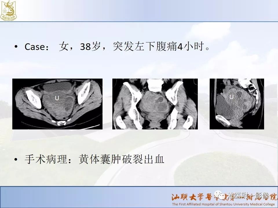 影像PPT - 【PPT】妇科急腹症的CT和MRI诊断-9