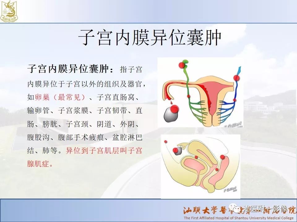 影像PPT - 【PPT】妇科急腹症的CT和MRI诊断-11