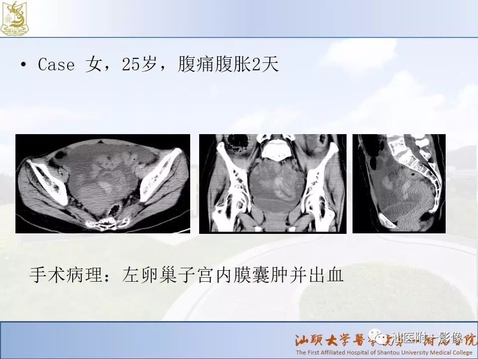 影像PPT - 【PPT】妇科急腹症的CT和MRI诊断-12