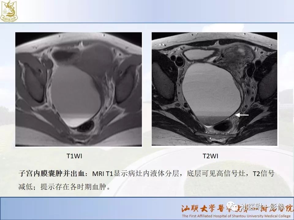 影像PPT - 【PPT】妇科急腹症的CT和MRI诊断-13