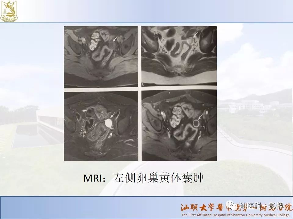 影像PPT - 【PPT】妇科急腹症的CT和MRI诊断-8