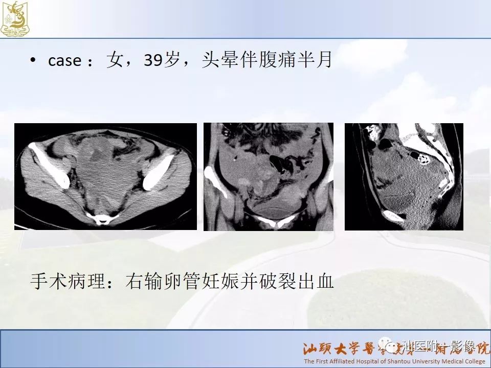 影像PPT - 【PPT】妇科急腹症的CT和MRI诊断-17