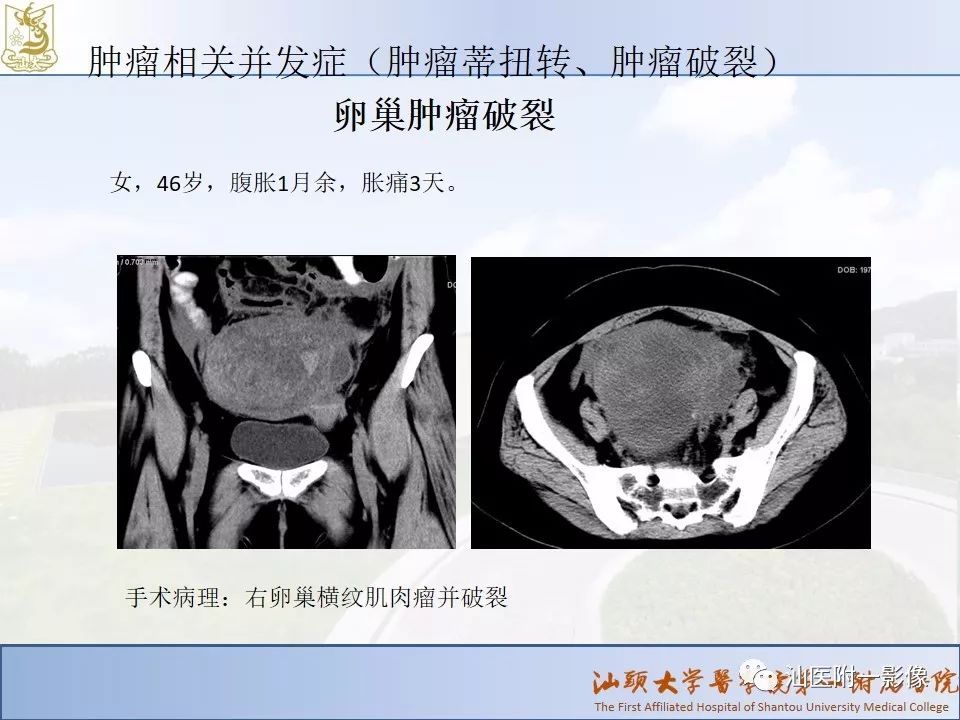 影像PPT - 【PPT】妇科急腹症的CT和MRI诊断-19