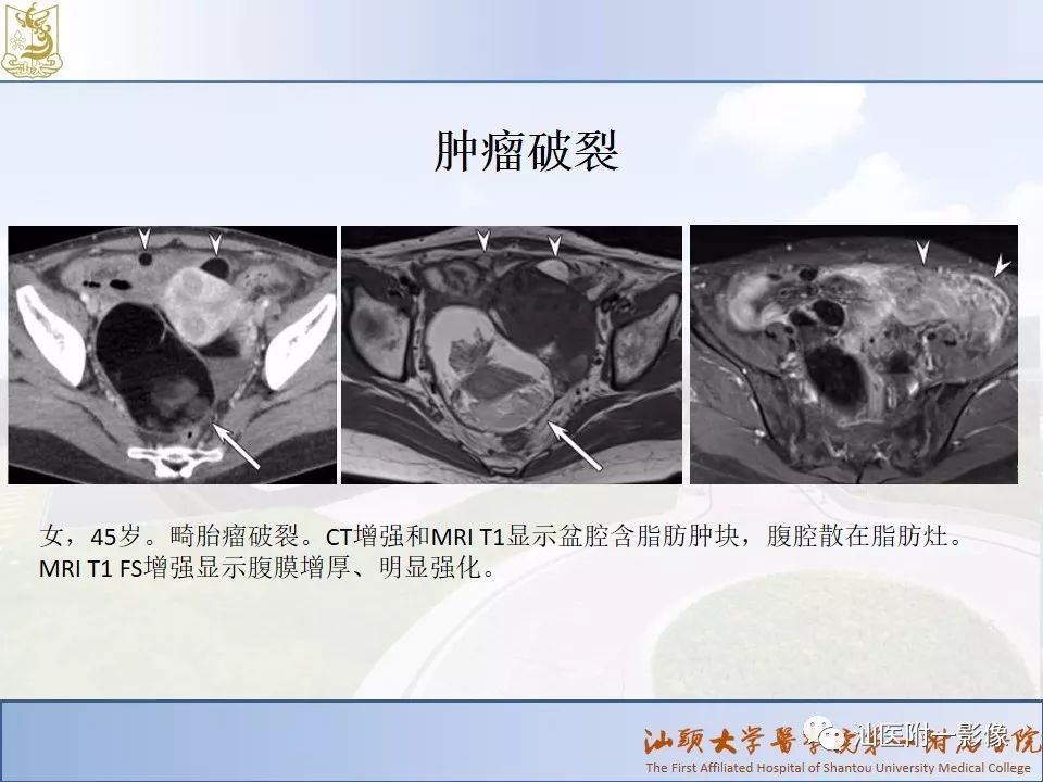 影像PPT - 【PPT】妇科急腹症的CT和MRI诊断-20