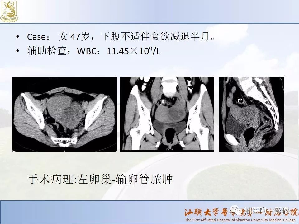影像PPT - 【PPT】妇科急腹症的CT和MRI诊断-24