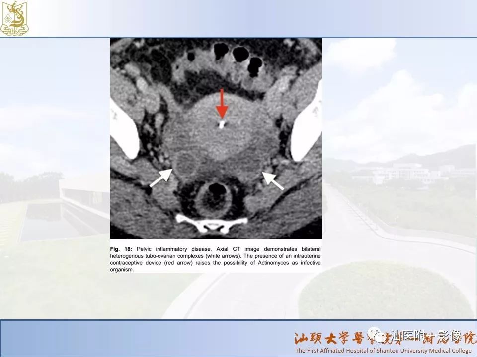 影像PPT - 【PPT】妇科急腹症的CT和MRI诊断-25