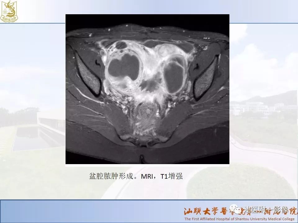 影像PPT - 【PPT】妇科急腹症的CT和MRI诊断-26