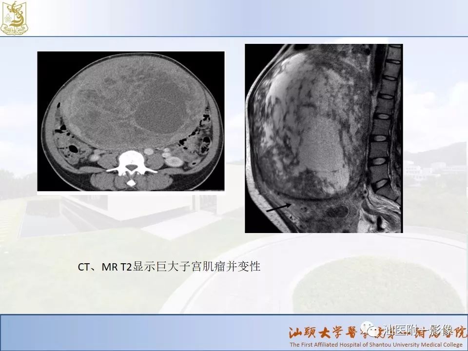 影像PPT - 【PPT】妇科急腹症的CT和MRI诊断-28