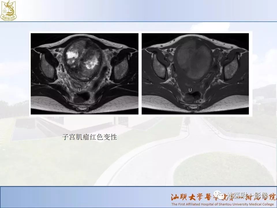 影像PPT - 【PPT】妇科急腹症的CT和MRI诊断-29